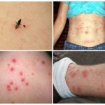 Allergy to flea bites