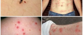 Аллергия на укус блох