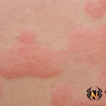 Аллергия от комариных укусов