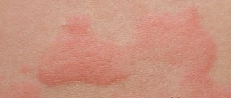 Allergy from mosquito bites
