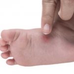 Чем лучше мазать укусы комаров у детей