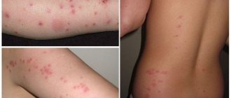 Photos of linen lice bites on the human body and proper treatment