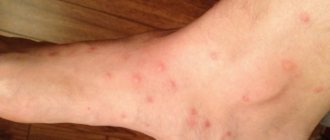 How to distinguish a bug bite from a flea bite