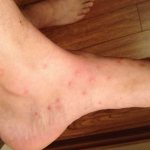 Как выглядят укусы блох