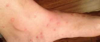 What do flea bites look like?