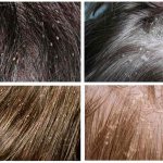 Как выглядят вши и гниды у человека