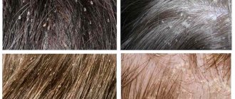 What lice and nits look like on humans