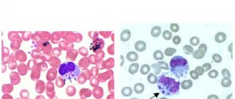 Tick-borne monocytic ehrlichiosis in humans. Blood test, symptoms and treatment