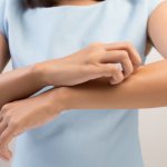 Лечение укуса насекомого