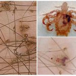 лобковые вши