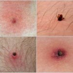 Can a tick fall off on its own after drinking blood?