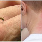 Swelling and redness from a mosquito bite - what to do and how to treat it