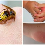 Отек от укуса осы