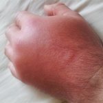 swelling from a wasp sting