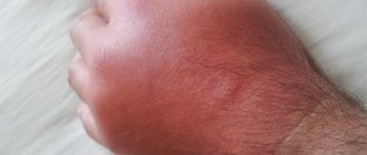 swelling from a wasp sting