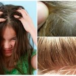 Where do lice come from in children? Pediculosis treatment and prevention 