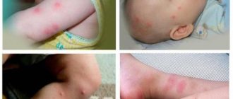 Первая помощь ребенку при укусах блох: медикаменты и народные средства