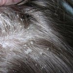 Почему чешется голова после моря