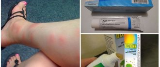 Why do mosquito bites cause bumps and an itchy body?