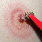 Посмотрим, как выглядят укусы клещей в норме и когда можно говорить о состоявшемся заражении опасной инфекцией...