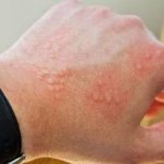 Manifestation of reaction on the hand