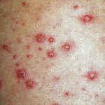 Симптоматика и признаки болезни