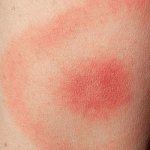 симптомы укусов клеща