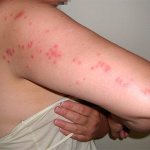 This is what a characteristic pattern of bed bug bites looks like on the body of their victim.