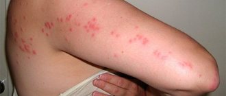 This is what a characteristic pattern of bed bug bites looks like on the body of their victim.