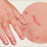 укусы клопов