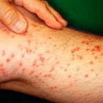 Укусы муравьев - фото на человеке