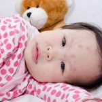 Укусы постельных клопов — Как выглядят и чем лечить (фото)