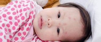 Bedbug bites - What they look like and how to treat (photo)