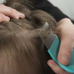 Timely detection of lice is a guarantee of quick relief from lice