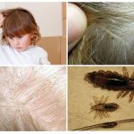 вши у ребенка