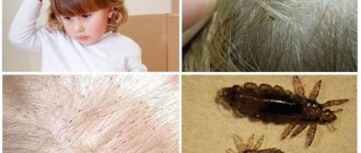 lice on a child